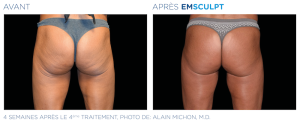 Emsculpt_PIC_Ba-card-female-buttock-044_FR100