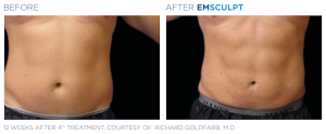 Emsculpt_PIC_Ba-card-male-abdomen-070_EN100