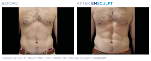 Emsculpt_PIC_Ba-card-male-abdomen-073_EN100